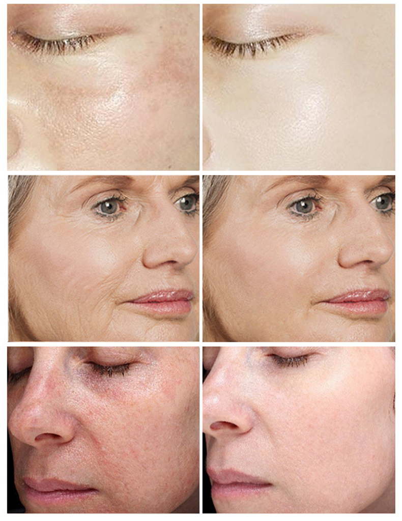 Best New Whitening Facial Mask With Vitamin C Serum And Hyaluronic Acid For Face Filling And Plumping Skin Care Beauty