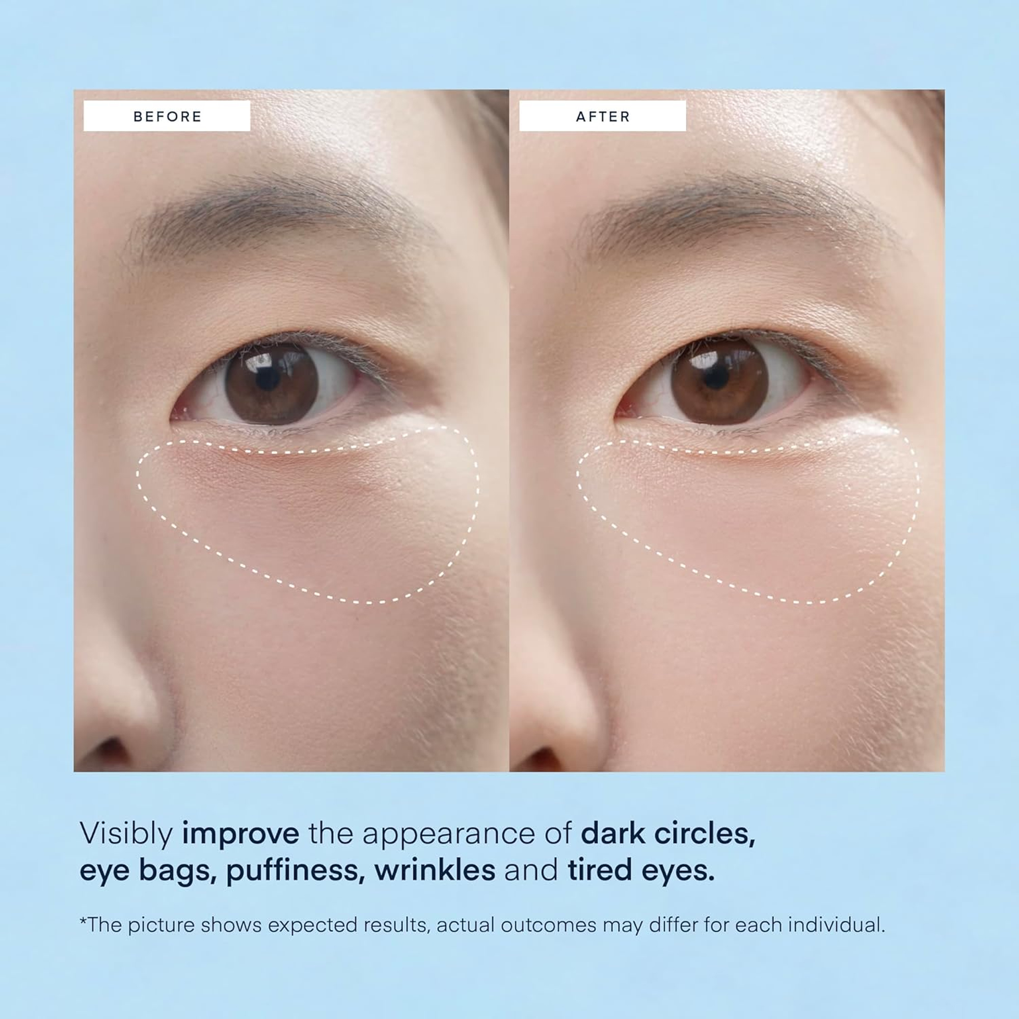 Private Label Blue Gel Eye Mask Cooling Fine Lines Under Eye Patches For Dark Circles Puffiness Bags