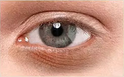 Black eye concern
