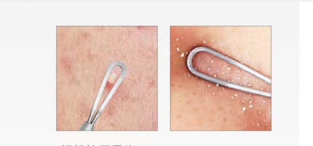 Acne Removal Tool