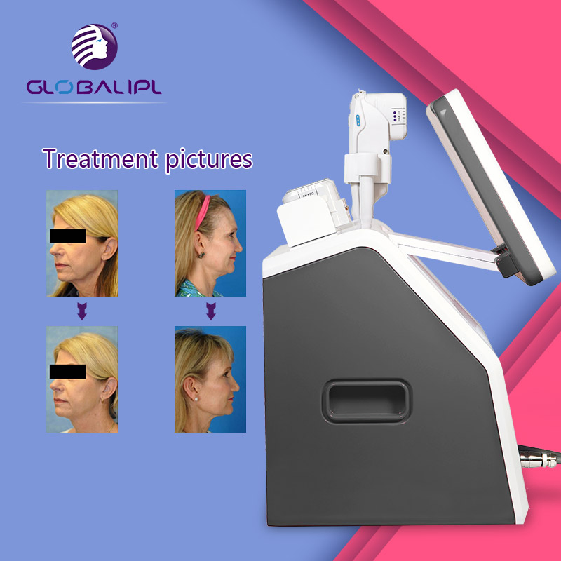 2020 Newest Hifu Device for Face Lift /Wrinkle Removal/Skin Tightening
