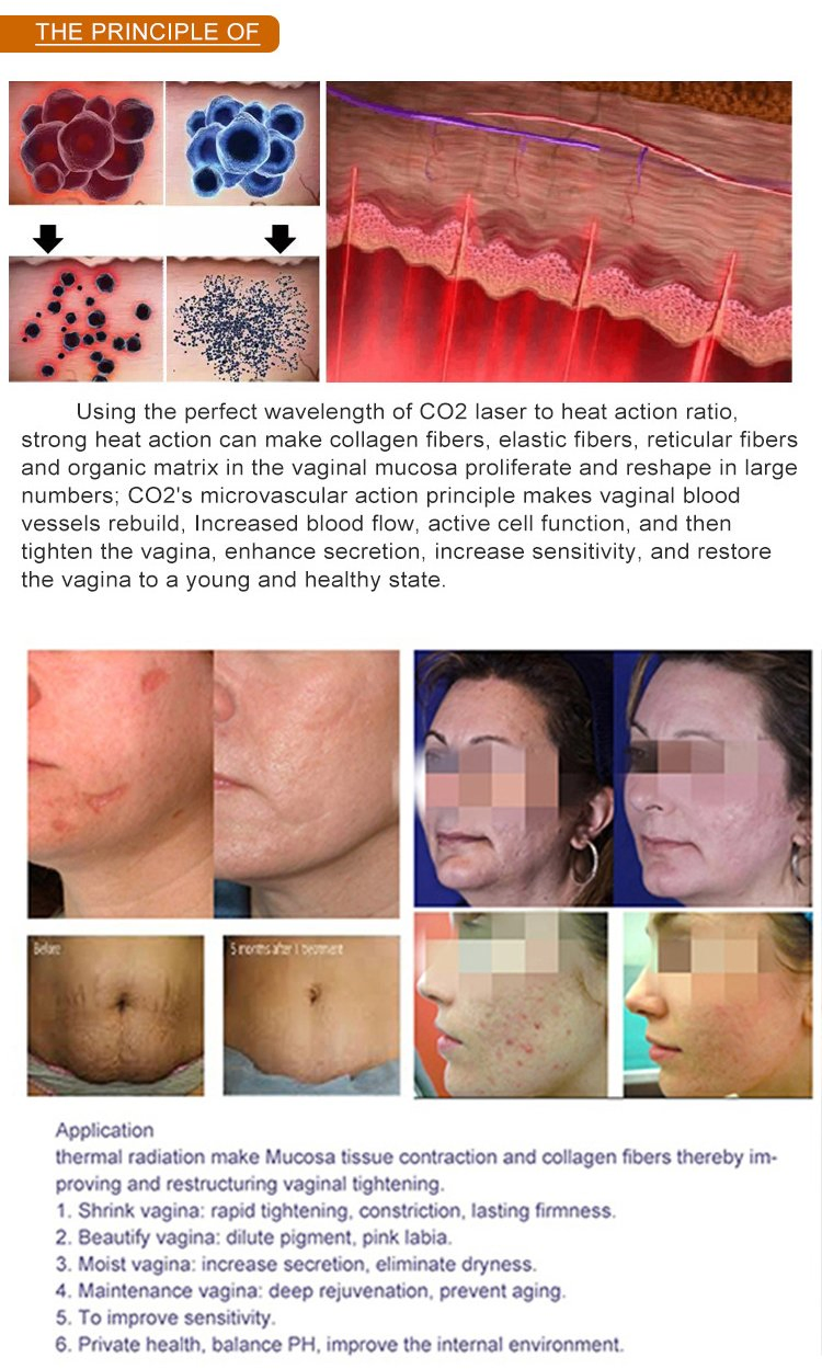 2026 Newest Portable Fractional CO2 Laser Anti-Aging, Skin Tightening &amp; 360° Vaginal Rejuvenation Professional Beauty Device with Skin Rejuvenation