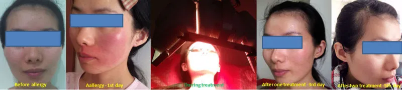 Anti-allergy skin treatment by LED phototherapy