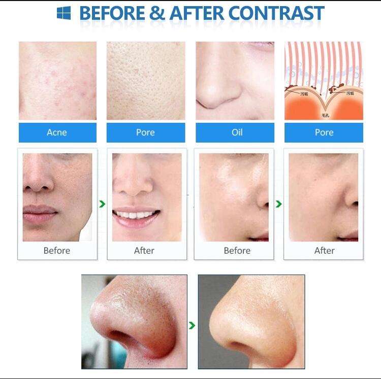 Blackhead Removal Beauty Instrument