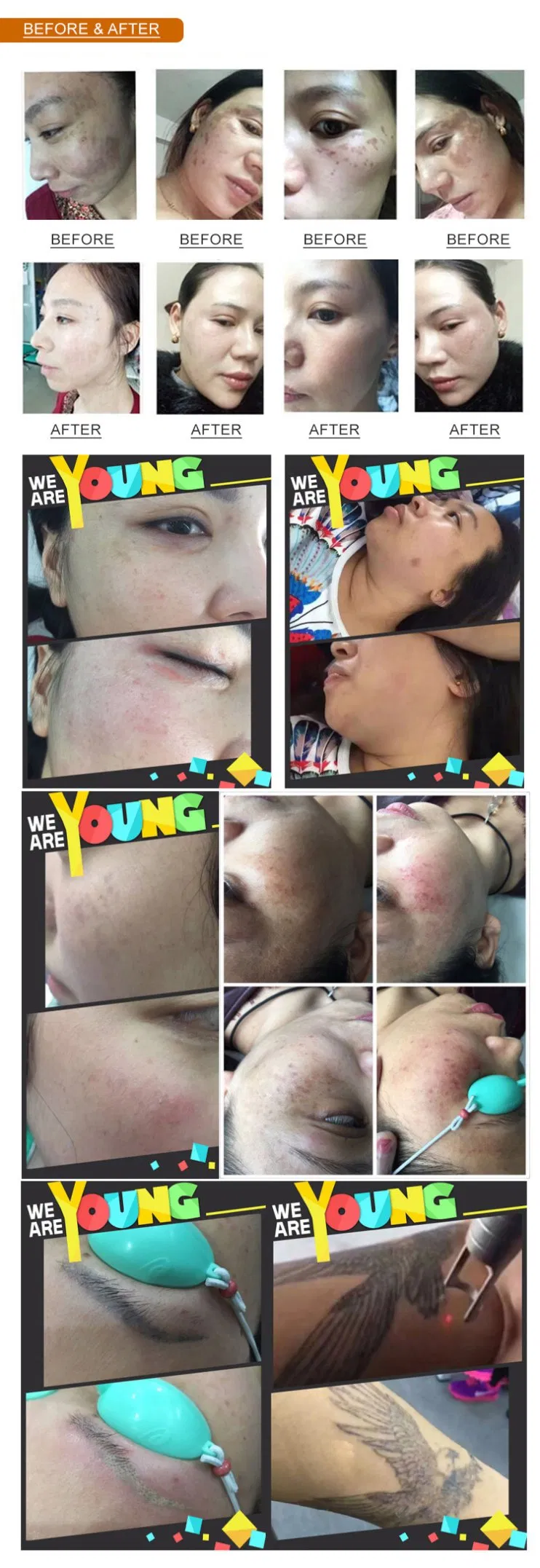 2026 Newest Portable Fractional CO2 Laser Anti-Aging, Skin Tightening &amp; 360° Vaginal Rejuvenation Professional Beauty Device with Skin Rejuvenation