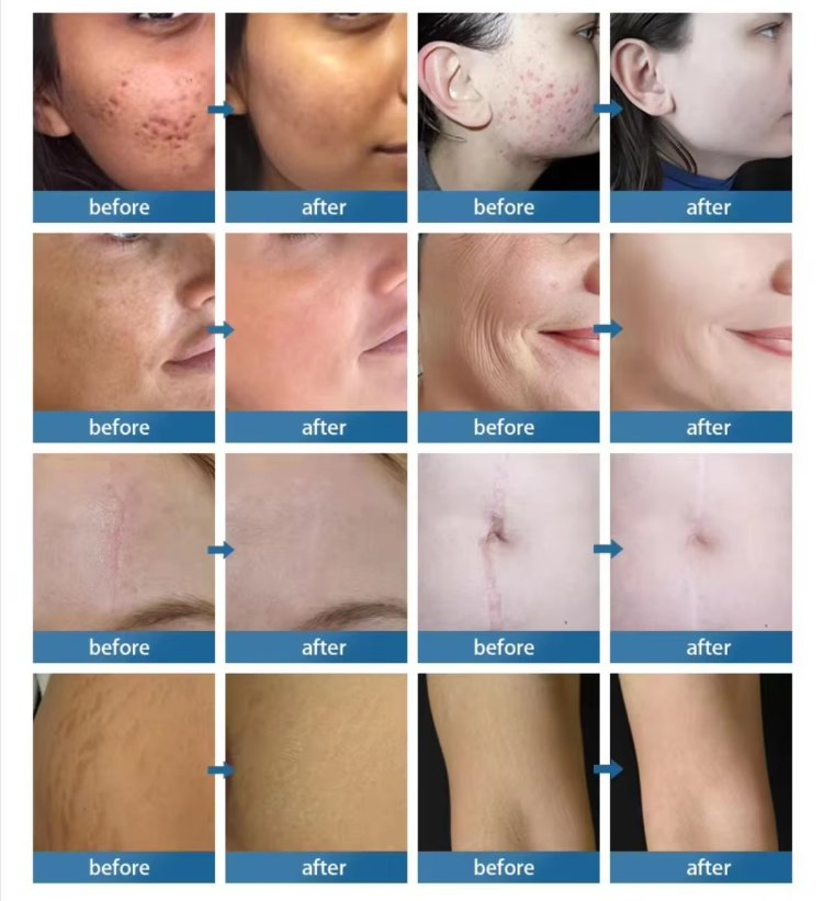 2026 Fractional CO2 Laser Device - Vaginal Tightening &amp; Scar Removal Skin Resurfacing CE Approved