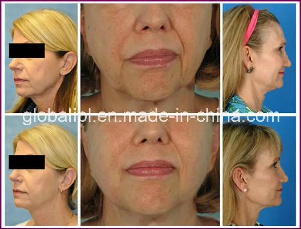 2020 Newest Hifu Device for Face Lift /Wrinkle Removal/Skin Tightening
