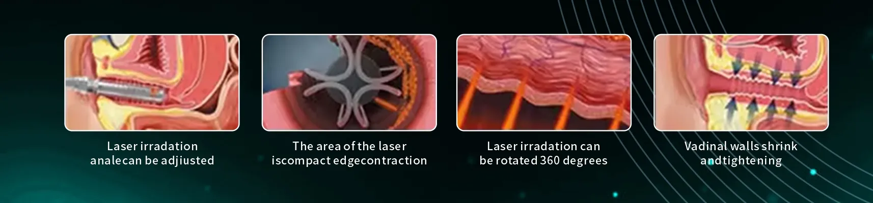 Vaginal Tightening Laser Treatment Chart