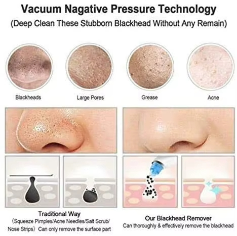 Vacuum Blackhead Remover Detail 7