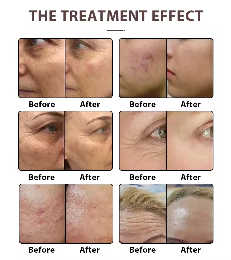 2026 Fractional CO2 Laser Device - Vaginal Tightening &amp; Scar Removal Skin Resurfacing CE Approved