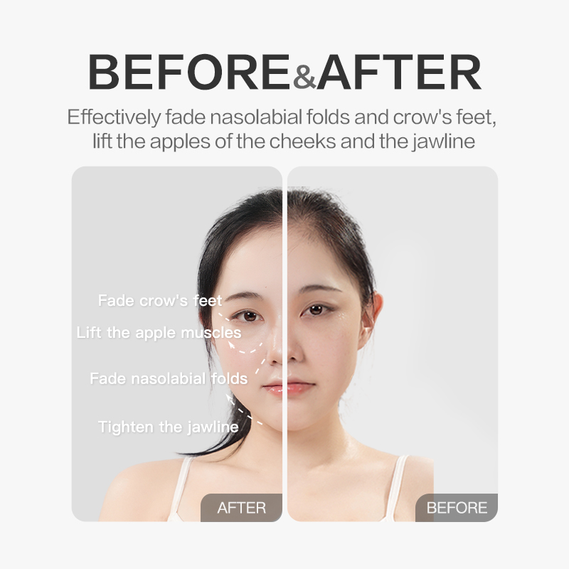 OEM/ODM Portable Flexible Facial Beauty Tool with 30 Free Refill Pads Skin Tightening Wrinkle-Reducing Device Low Supported