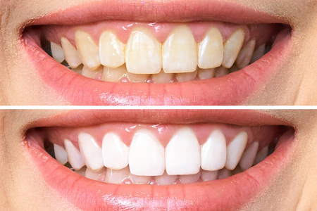 LED Charging Device Advance Whitening Plus Infrared Light Fashion Design 16/32 Led Wireless Teeth Whitening Light