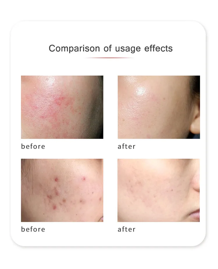 Skin Whitening Device
