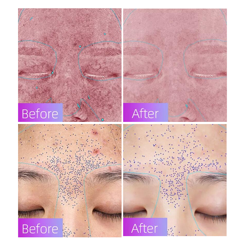 New Arrival 7 Colors LED Body Skin Care Device Professional Home Use Anti-Aging Skin Management with Wireless Remote Control