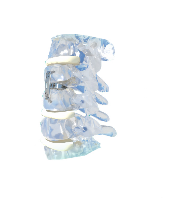 Orthopedic Implant Cervical Interbody Fusion Cage Arc-shaped Wedge-shaped PEEK Titanium Alloy OEM Fule Brand CE Certified 5-Year