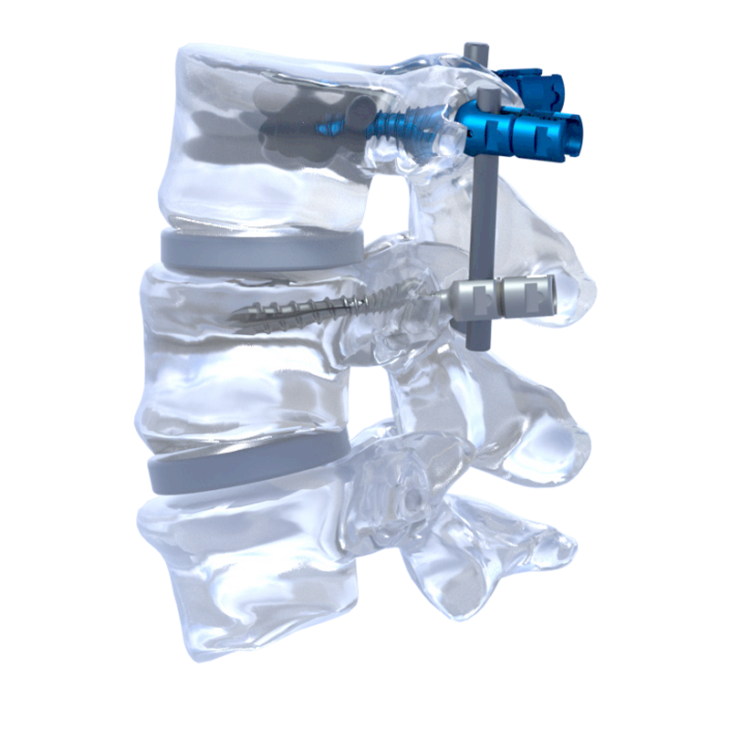 Anterior Cervical Spine Plate System Titanium Orthopedic Surgery Implant Medical Device Treating Scoliosis Interventional Class