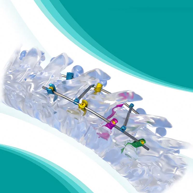 Fule Orthopedic Medical Implant Titanium 5.0mmCSS System CE Certified 5-Year Warranty for Spine Surgery