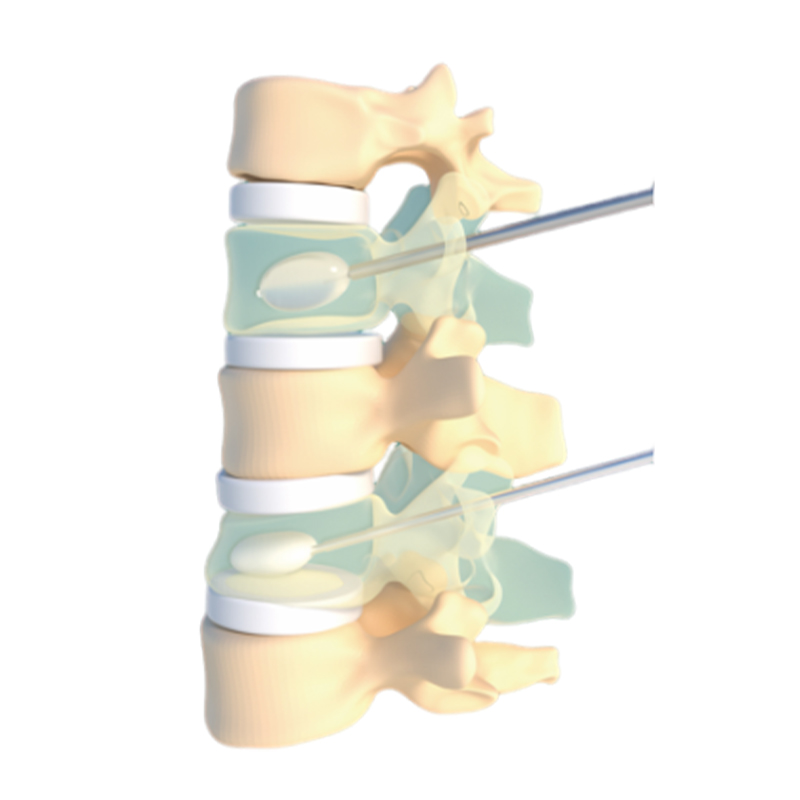 Professional Implantable Medical Needle Kyphoplasty/Vertebroplasty Metal Material CE Certified 5-Year Warranty Factory Direct
