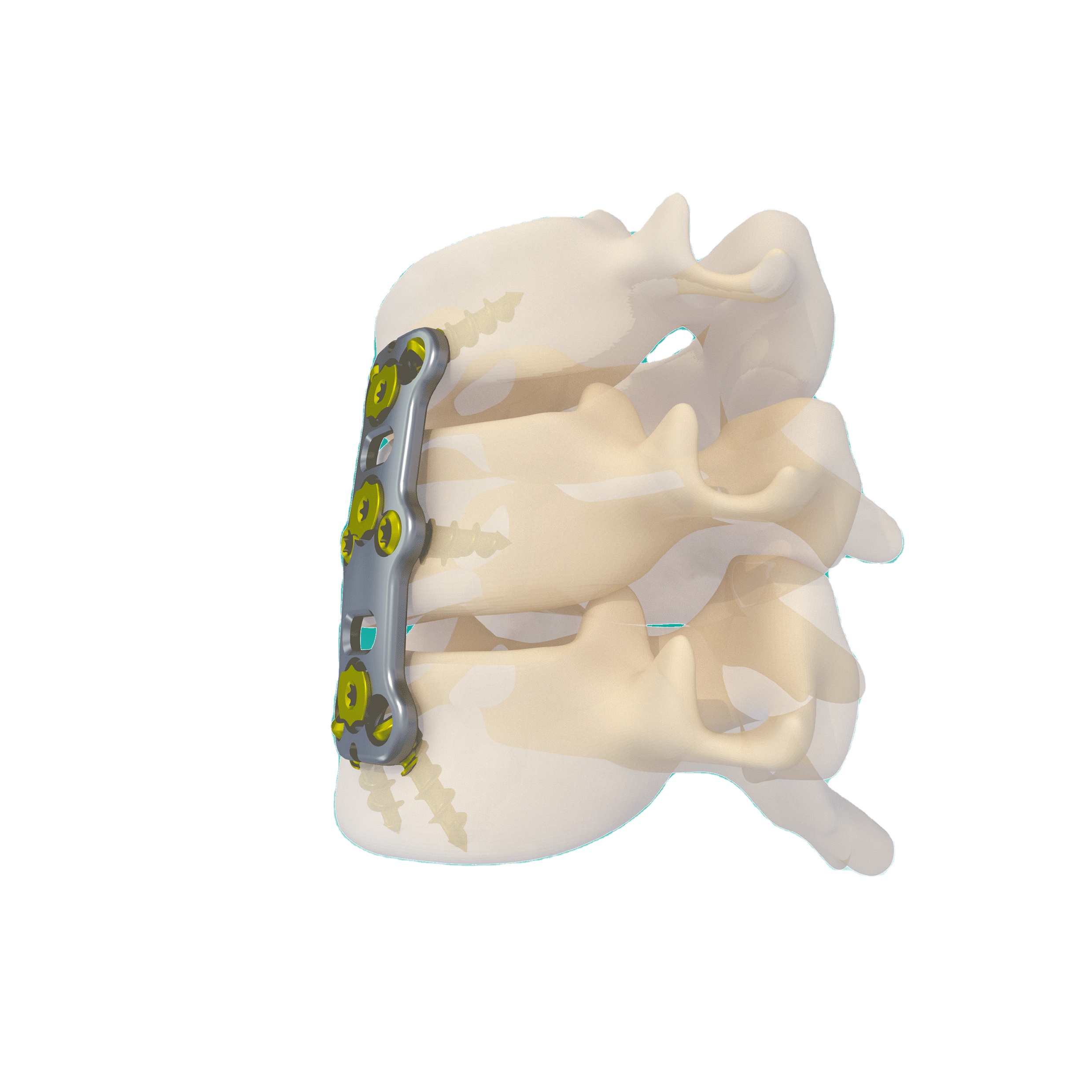 Customized Titanium FJQ-d Anterior Cervical Plate and Screws for Spinal Fixation