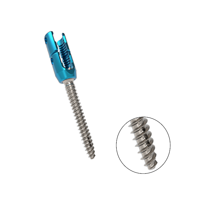DHL Titanium Fedex Customized Medical Screw COX II Bone Cement Pedicle Screw 6.0 System for the Treatment of Osteoporosis