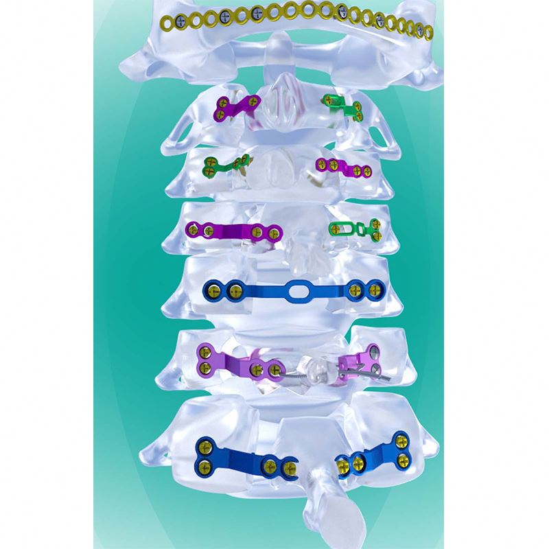High Quality Posterior Cervical Laminoplasty Surgical System for Enhanced Spinal Decompression