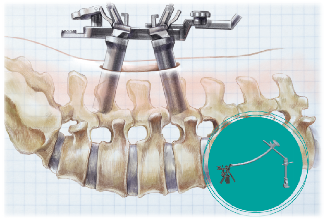 High Quality Class III Minimally Invasive Instruments CE Certified 2-Year Warranty China Manufactured