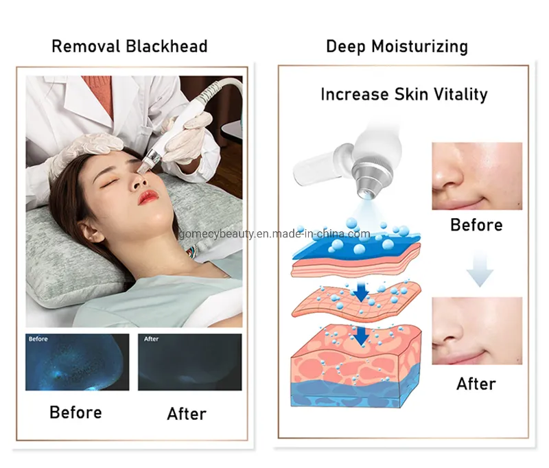 7 in 1 Jet Peel Oxygen Jet System 6-Polar RF Aqua Peel Hydra Dermabrasion Oxygen Facial Machine