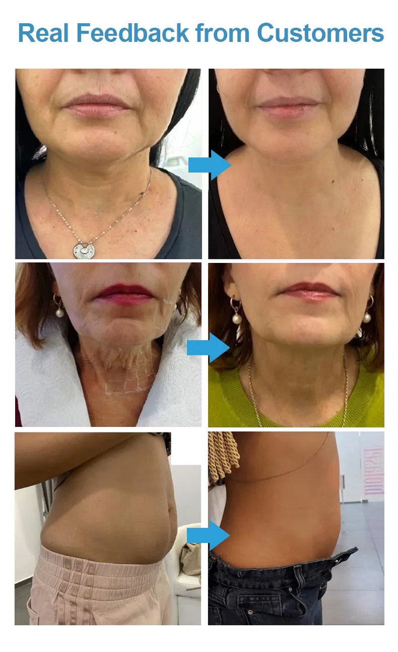 Professional Hifu Machine RF to Facial Fat Reduction Face Lifting 7D Hifu for Home Use