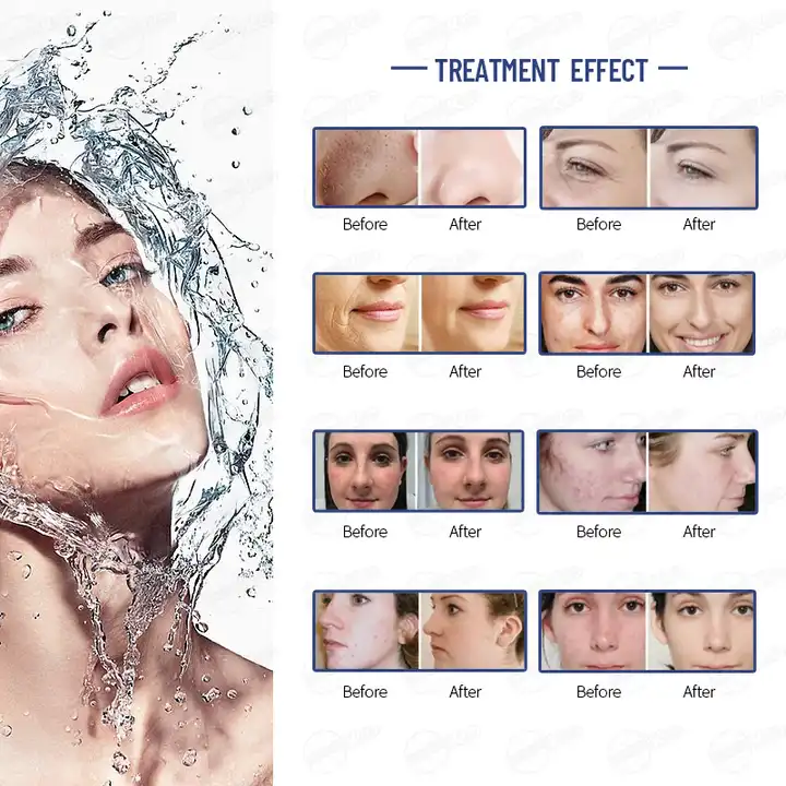Hydro dermabrasion Feature 9
