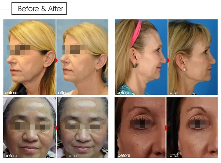 Hifu Ultrasound Facial Lifting Tightening Hifu Machine Feature Details