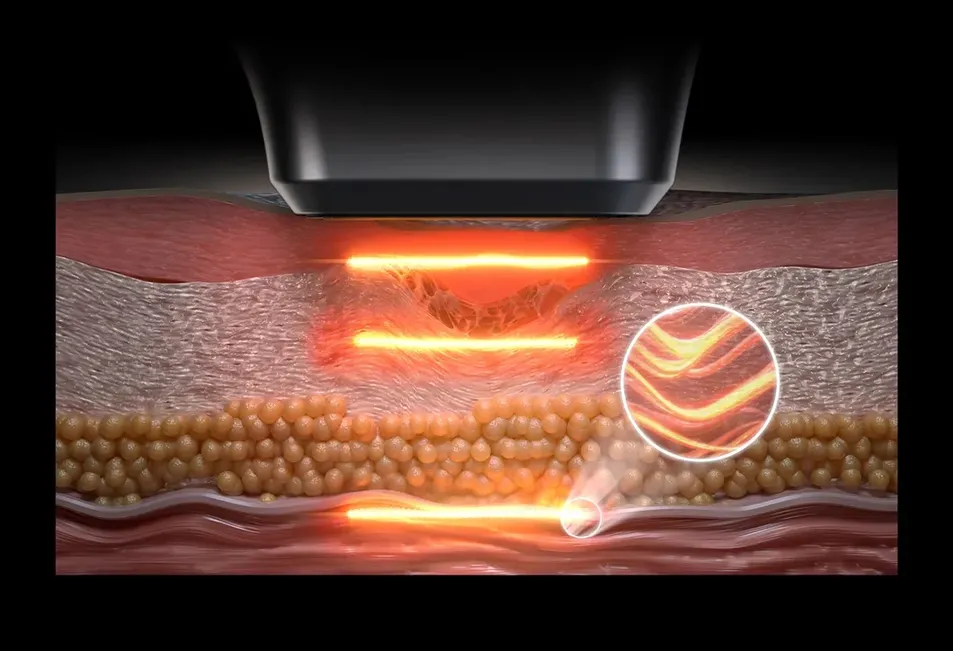 Hifu Precision Focusing System