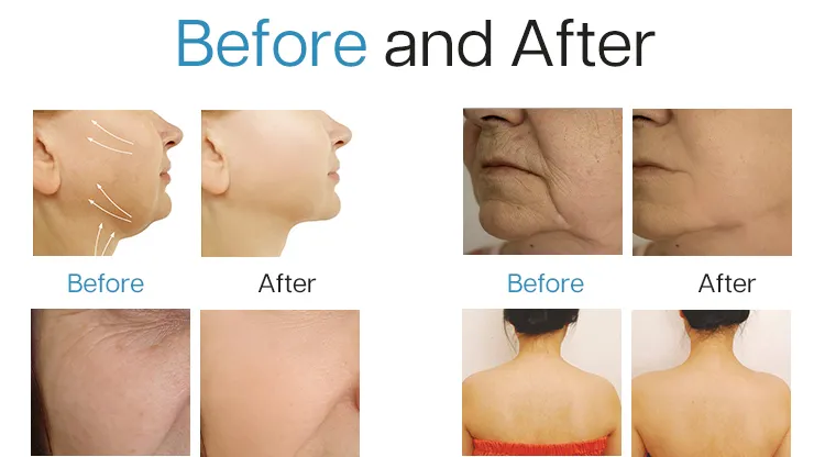 Advanced Non-Invasive EMS Facial Beauty Machine for Youthful Skin
