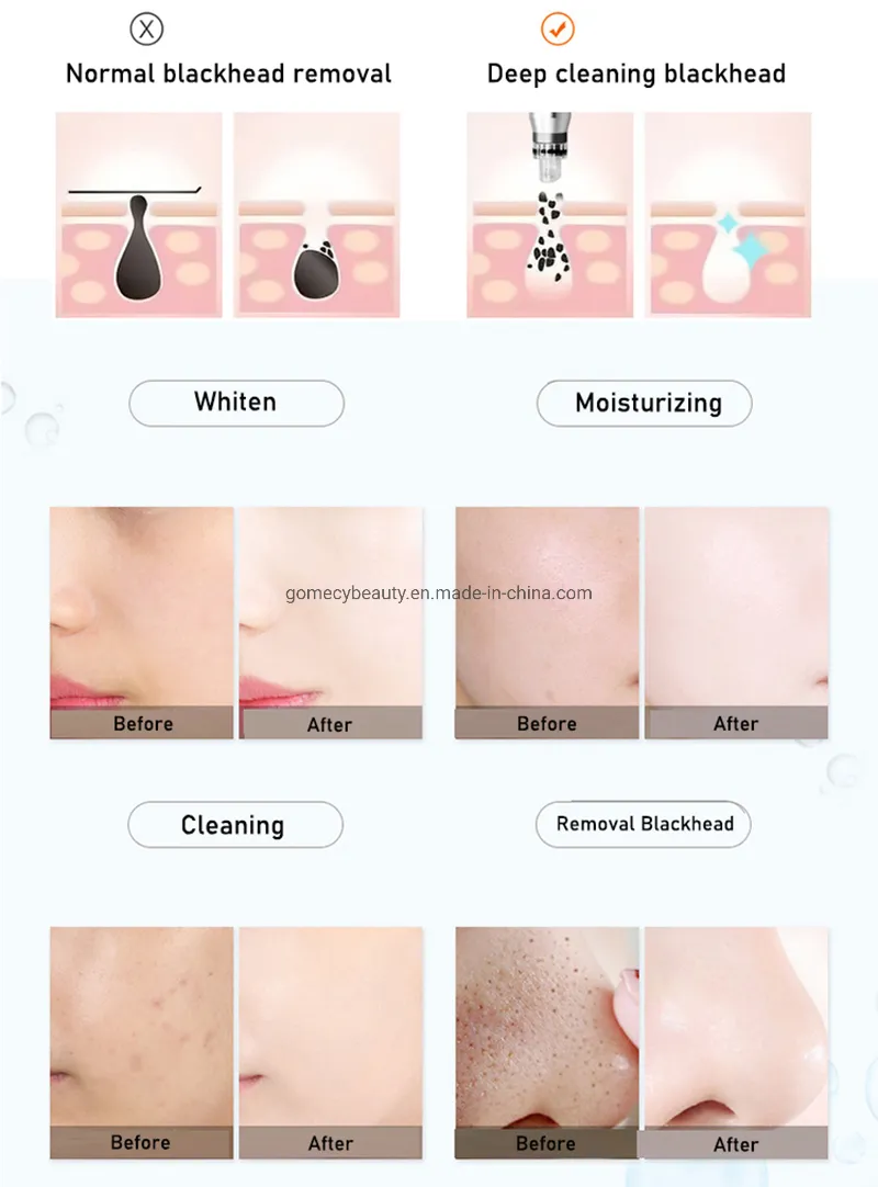 7 in 1 Jet Peel Oxygen Jet System 6-Polar RF Aqua Peel Hydra Dermabrasion Oxygen Facial Machine