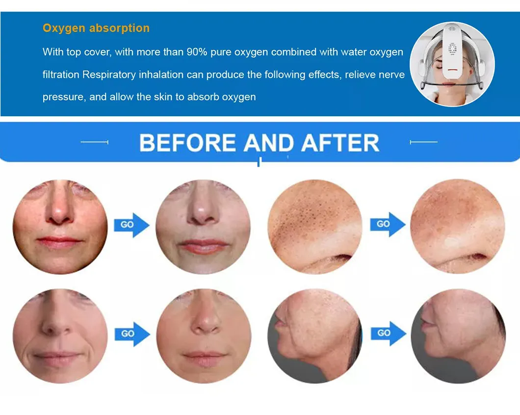 Hydro Dermabrasion Treatment Results
