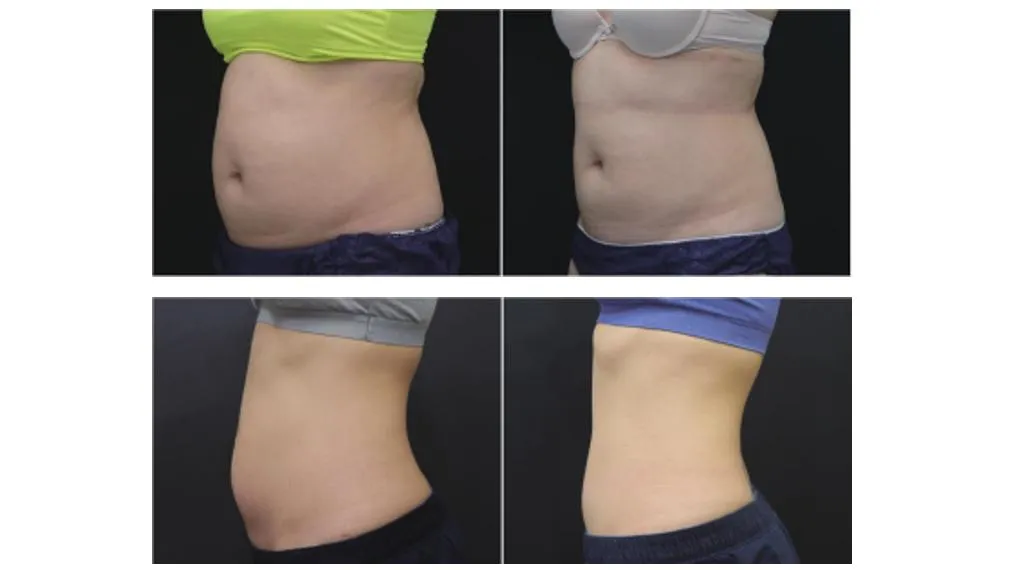 6 in 1 Ultrasound Cavitation RF Facial Body Slimming Machine