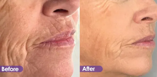 Lip wrinkle removal and firming Before and After