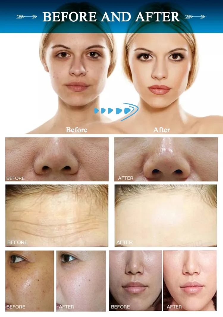 Korean Skin Care Beauty Facial Beauty Machine