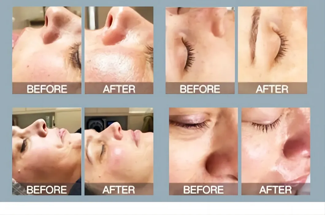 SPA Hydra Care Microdermabrasion Parameter 5