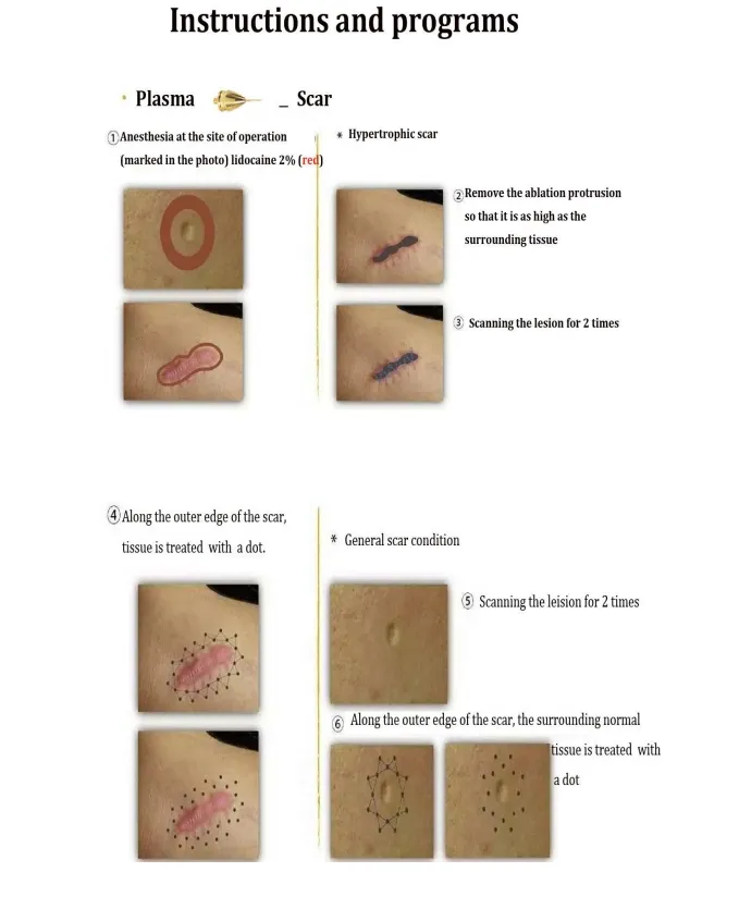 Treatment Handle Tips Detailed View
