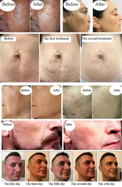 Ozone Plasma Pen Treatment Effect