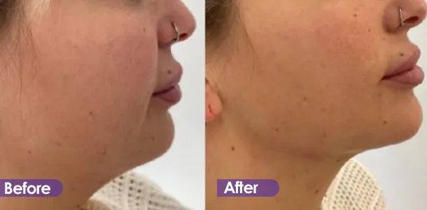 Jawline tightening Before and After