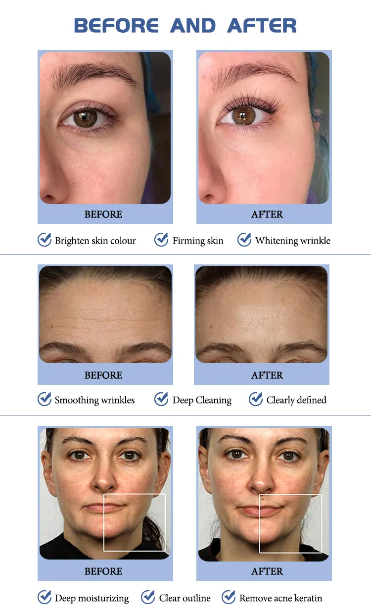 Multi-Functional RF Facial Beauty Instrument Diamond Dermabrasion Skin Whitening Deep Cleaning Salon Machine
