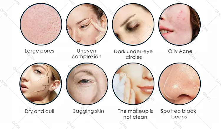 Hydro-dermabrasion treatment