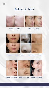 Portable Oxygen Hydra Skin Smoothing Beauty Machine Oxygen Infusion &amp; Dermabrasion For Comprehensive Skin Rejuvenation
