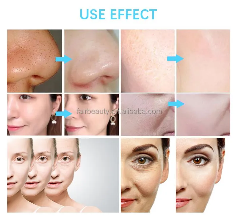 Professional Beauty Oxygen Jet Microdermabrasion Oxygen Facial Skin Tightening Machine