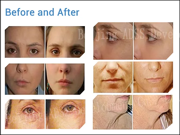 Oxygen Facial Machine View 1
