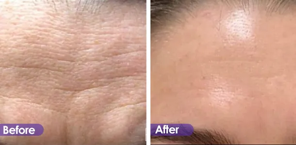Forehead wrinkle removal result