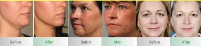 Hifu treatment before and after comparison