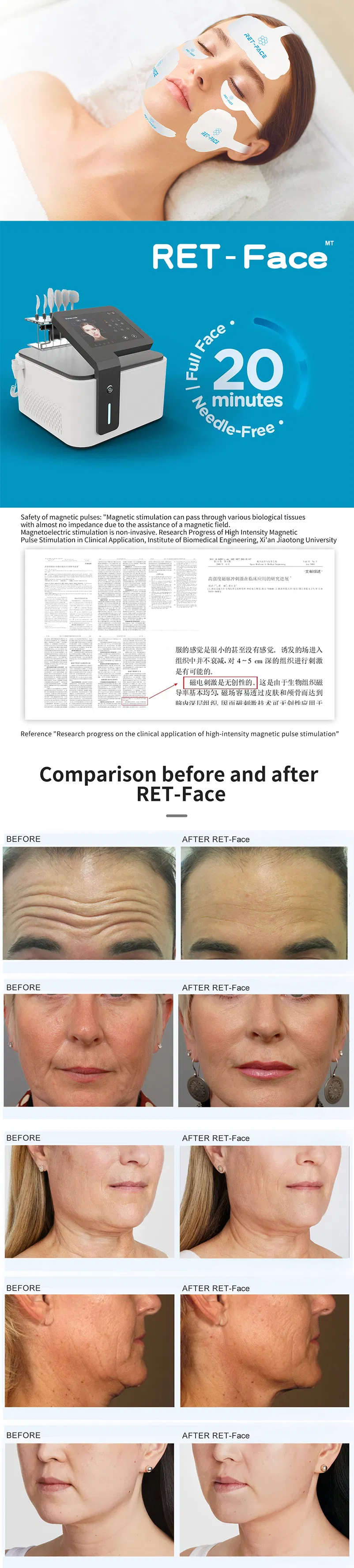 EMS Lift Facial Electrostimulation Facial Radiofrequencyen RF Electro Muskl Stimulating Face Lifting EMS Skin Tightening Machine