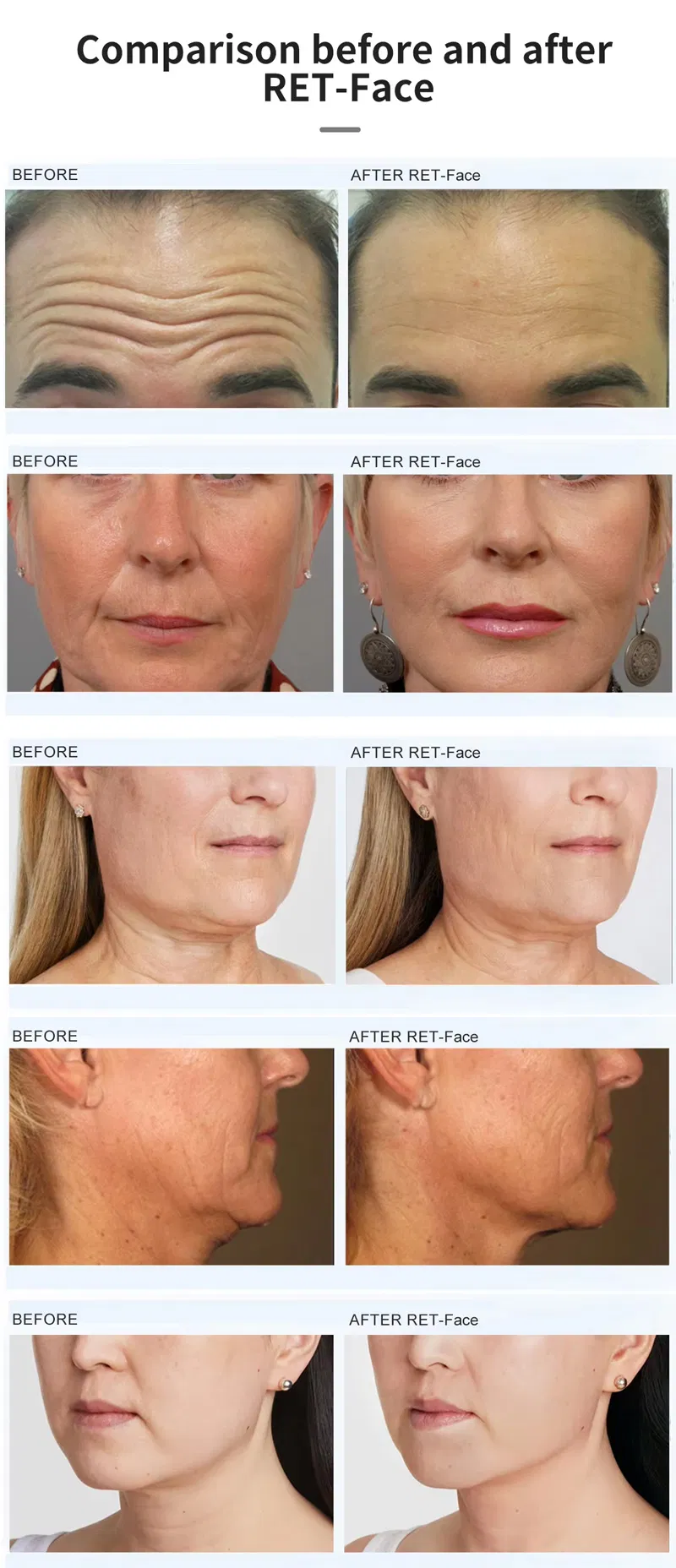 Powerful High Frequency Facial Machine EMS RF Face for Jowl Lifting Wrinkles Removal EMS RF Face Tightening Beauty Device